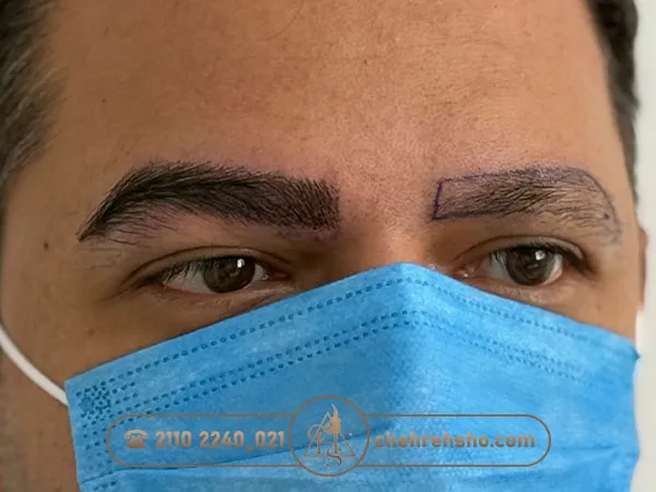 کاشت ابرو مردانه با خواب و زاویه طبیعی با تکنیک میکروپلاسما
