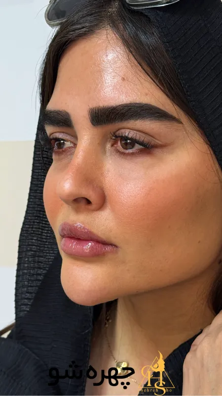 کاشت ابرو پوست چرب و ضخیم (آیا چربی پوست مانع است؟)