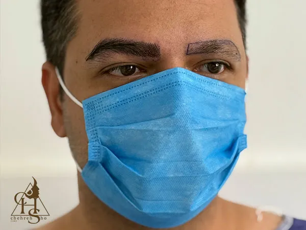کاشت ابرو مردانه با خواب و زاویه طبیعی با تکنیک میکروپلاسما